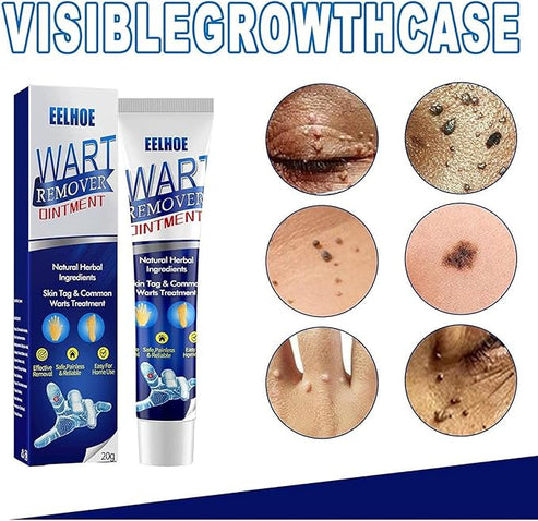 🔥 Last Day Of Discount! Wart Remover Instant Blemish Removal Cream 🛒✨